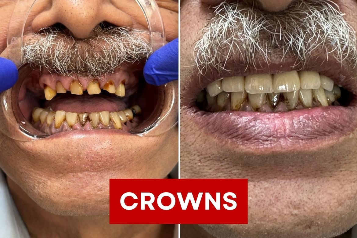 Dental Crowns in Dwarka