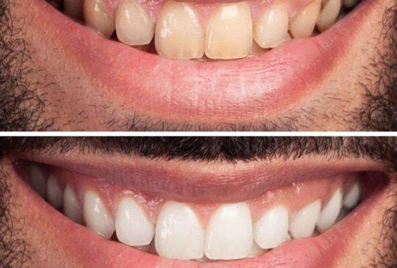 Teeth whitening with the ZOOM technique