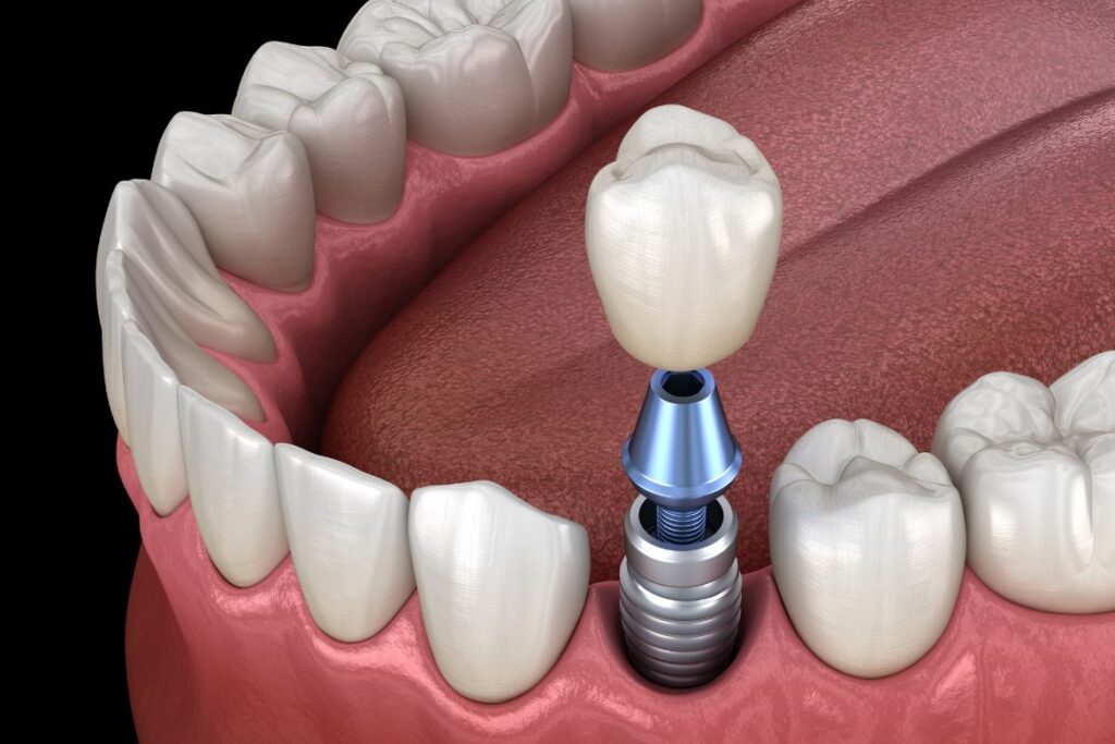Single tooth implant
