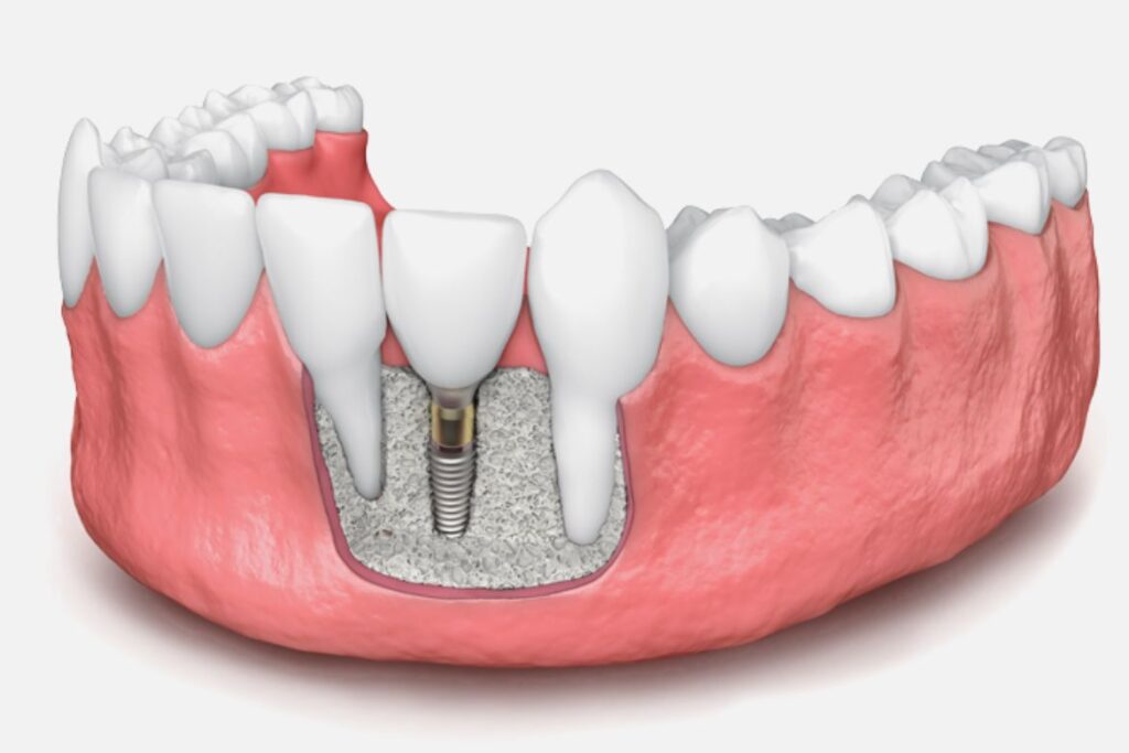 bone grafting for dental implant