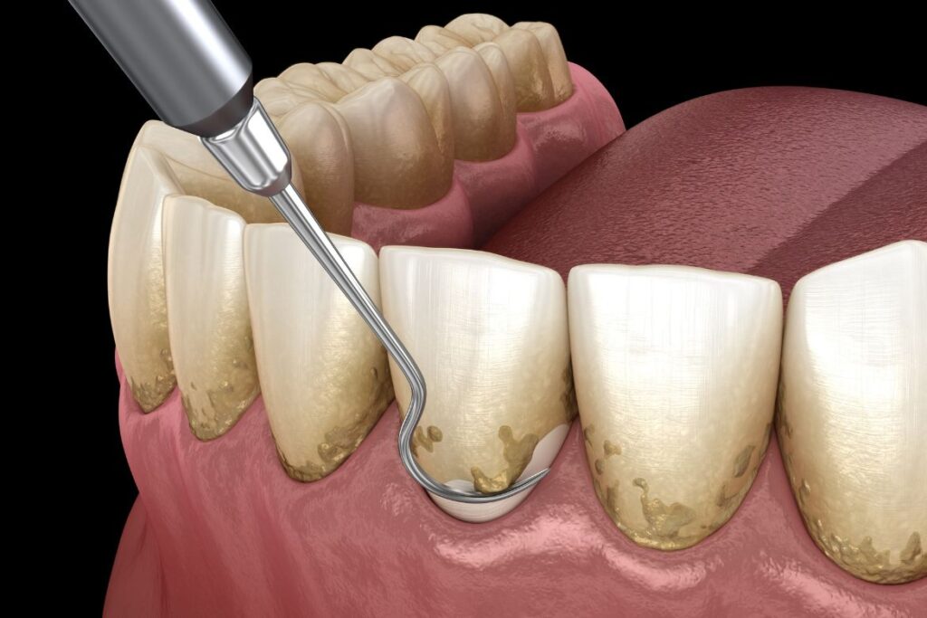 stain removal of teeth and gums