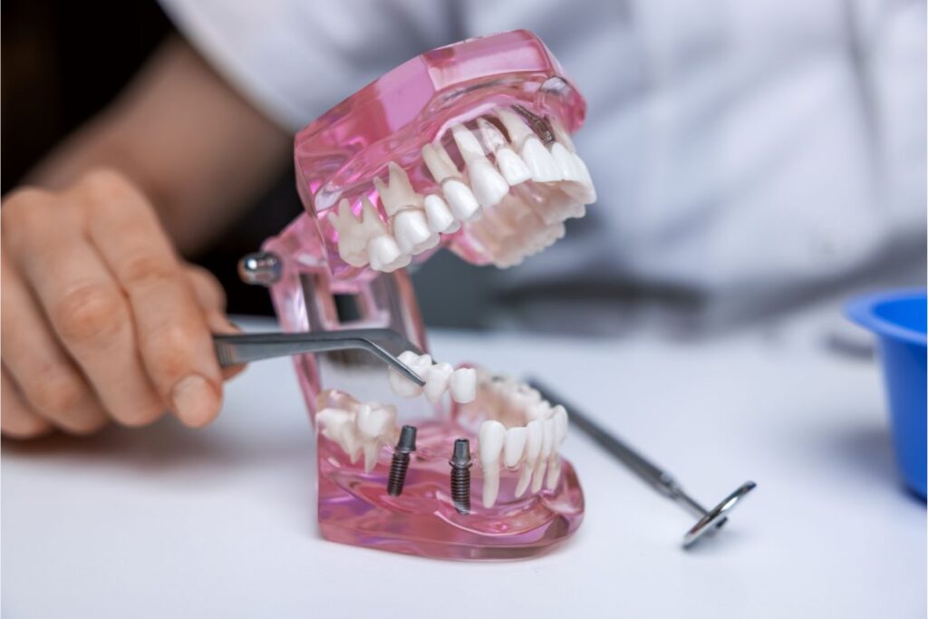 Multiple teeth implant in dwarka