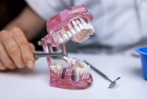 Multiple Teeth Implant