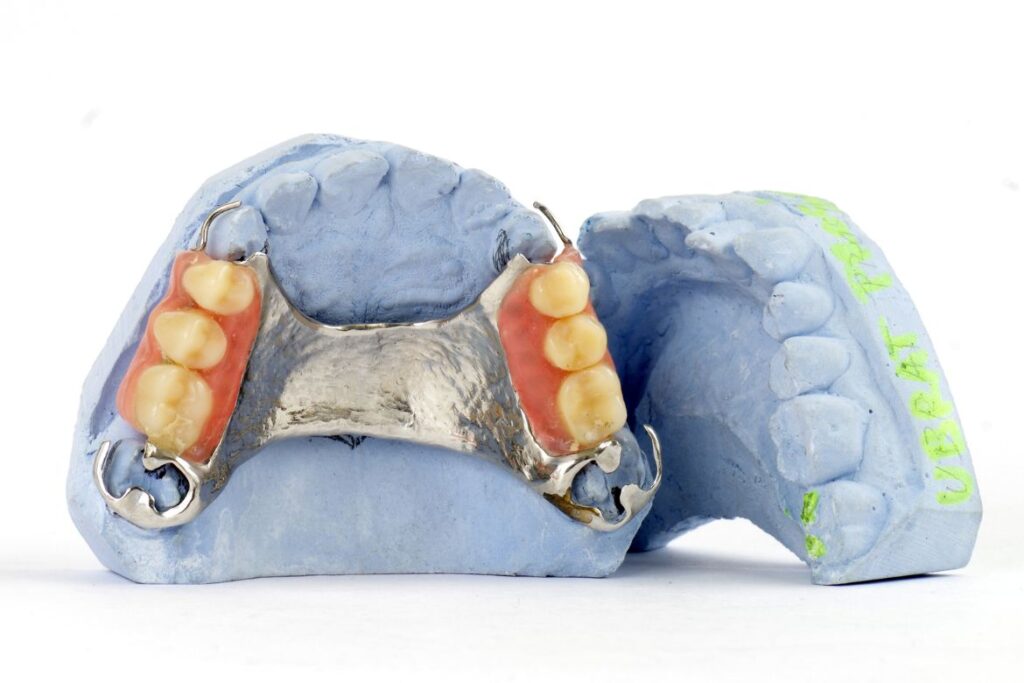 cast partial dentures