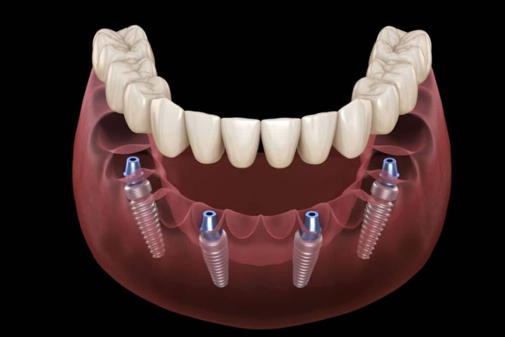 dull mouth implant supported dentures