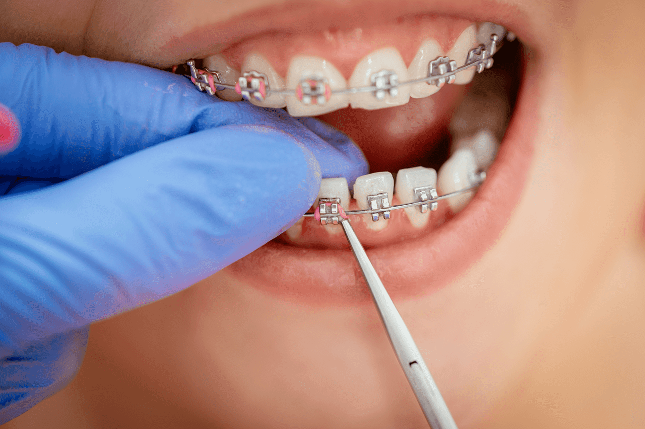 Can Invisible Braces Fix Teeth?